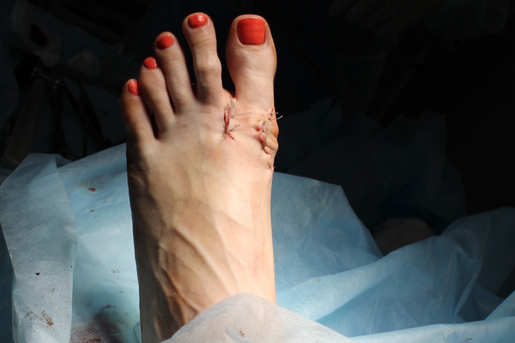 Реабилитация после операции на вальгусную деформацию первого пальца стопы