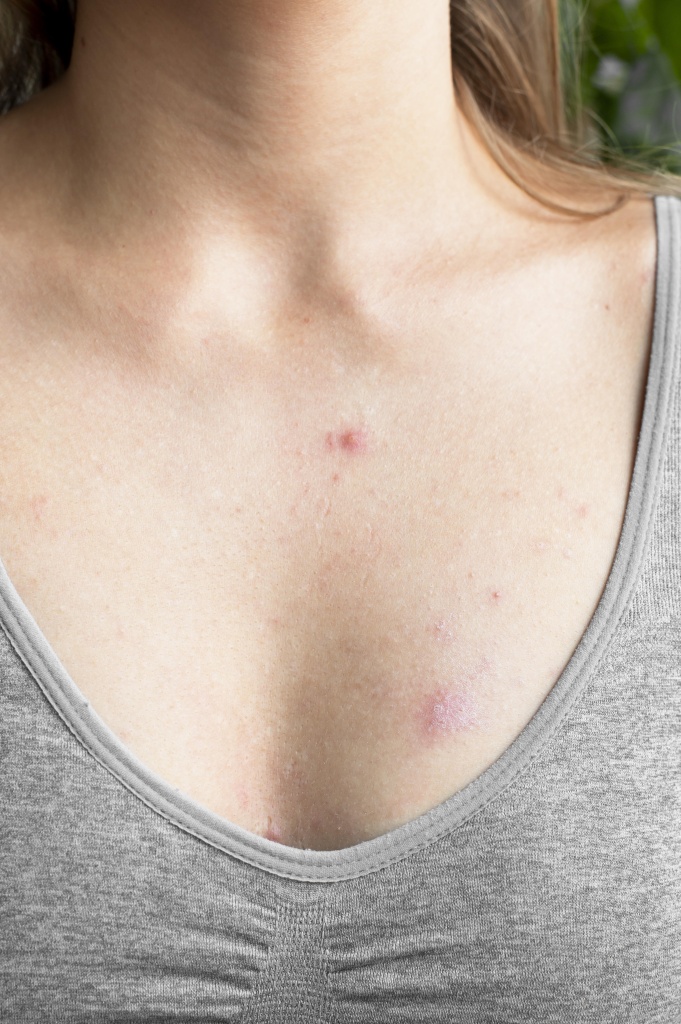 young-woman-having-skin-allergy.jpg