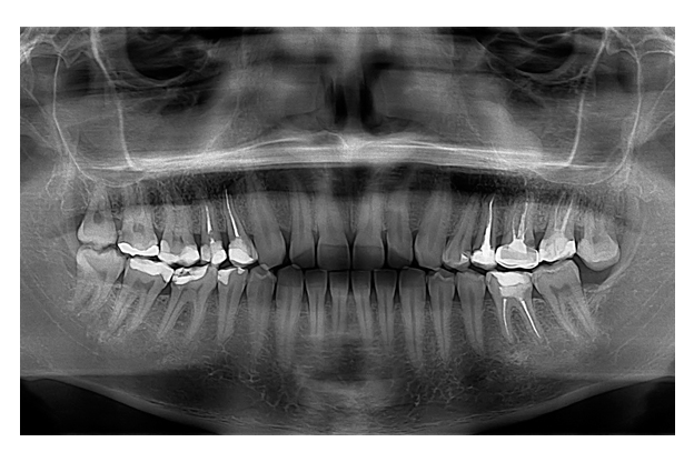 Ортопаннограмма зубов