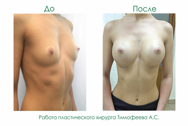 До и после увеличения груди работа пластического хирурга Тимофеева А.С.