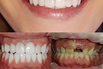 Комплексное функционально-эстетическое протезирование керамическими коронками цвета «Блич» на живых зубах с восстановлением сильно разрушенного зуба.