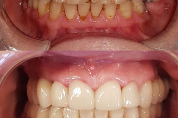 Комплексное протезирование циркониевыми коронками на зубах и имплантатах