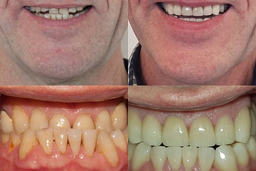 Протезирование керамическими коронками и винирами при неправильном прикусе и патологической стираемости зубов.