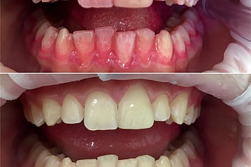 Индикация зубного налёта и гигиеническая чистка - стоматолог Скорикова Е.С.