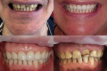 Протезирование керамическими коронками на живых зубах при генерализованной патологической стираемости зубов
