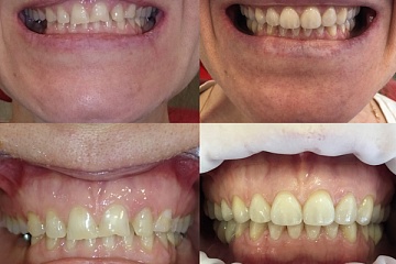 Комплексное функционально-эстетическое протезирование на живых зубах цельнокерамическими коронками и винирами.