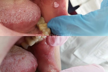Фиброма щеки в результате хронической травмы зубами
