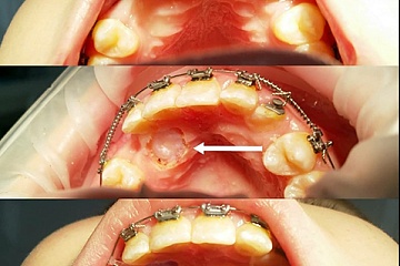 Раскрытие ретенированного дистопированного клыка для перемещения в зубной ряд