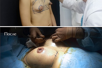 Увеличение груди и коррекция ореолов. Пластический хирург Шварцман И.А.