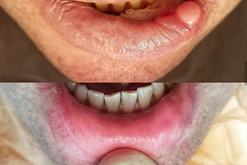 Фиброма нижней губы в следствии хронической травмы (прикусывание)