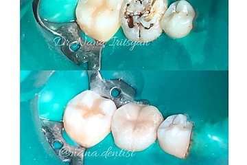 Реставрация. Зуб 4.6 - восстановление анатомической целостности и функции зуба путём прямой композитной реставрации.