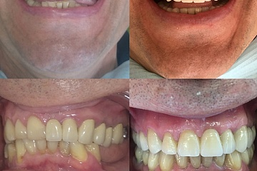 Замена старых металлокерамических мостовидных протезов и коронок на циркониевые с дентальной имплантацией в области отсутствующих зубов.