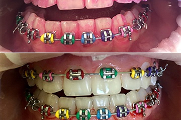 Профессиональная гигиена полости рта - стоматолог Скорикова Е.С.