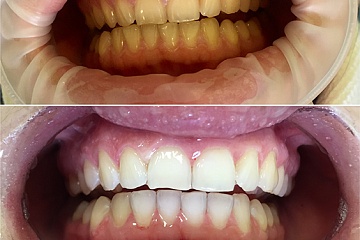 Профессиональная гигиена полости рта - стоматолог Скорикова Е.С.